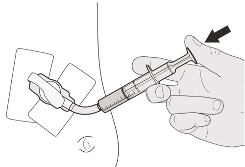 A hand holds a syringe with a needle inserted into a medical device connected to two skin patches, with a black arrow pointing upward