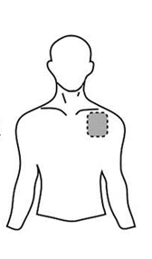Dibujo esquemático del torso de un hombre con un círculo punteado que indica la colocación de un parche en la parte superior del pecho izquierdo