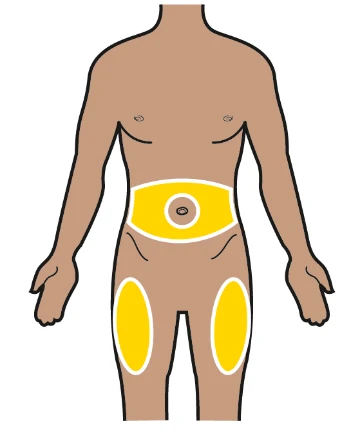Diagram of a male torso with three yellow areas highlighted on the abdominal region and upper right and left thighs