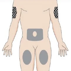 Human body diagram with gray areas on the abdomen and thighs and black mesh-patterned zones on the upper arms