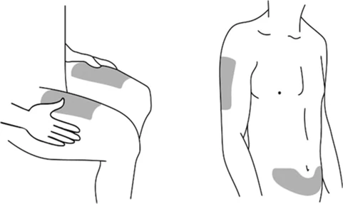 Schematic drawing of a human figure showing body areas for patch application, specifically the upper arm and the