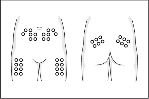 Diagram of the human body showing the arrangement of small black circles on the