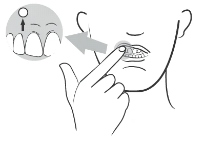 Schematic drawing of a hand pointing at a tooth with a dark spot, close-up of the tooth showing a lesion on the upper surface