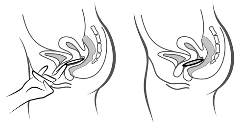Diagrama médico que muestra dos perfiles laterales de la pelvis femenina, con una mano que inserta un aplicador en el