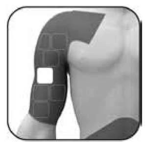 Diagram of the male torso showing placement of square patches on the upper and lateral part of the right arm