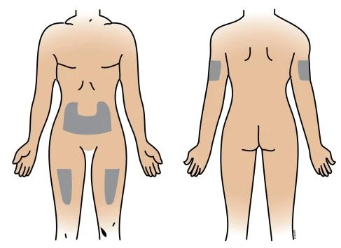 Diagrama del cuerpo humano que muestra zonas de aplicación con áreas grises sobre la piel