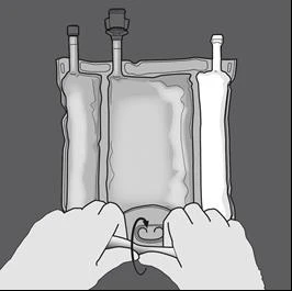Two hands pressing the bottom of an infusion bag containing liquid to expel the