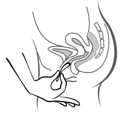 Dibujo esquemático que muestra una mano aplicando un dispositivo médico sobre la zona del seno para el