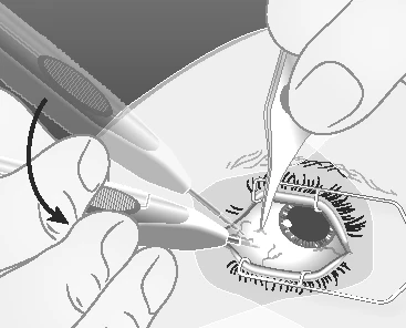 Ilustracja medyczna przedstawiająca ręce używające pęsety i aplikatora do umieszczenia urządzenia w oku