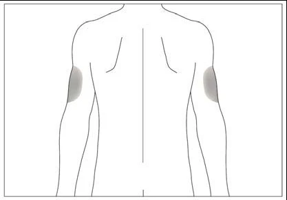 Dibujo esquemático de la espalda de un hombre con dos áreas grises que indican los puntos de inyección en la parte superior de los brazos