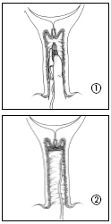 Two-phase medical diagram showing the