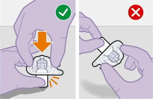 Two gloved hands handling a medical device with an orange downward arrow, a green checkmark on the left, and a red X on the right