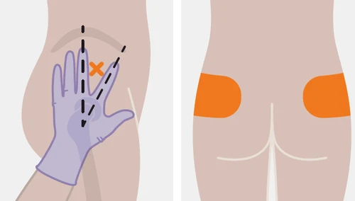 Medical illustration of two figures showing the gluteal area with a gloved hand indicating a location