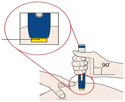 Ilustración médica que muestra una mano que sostiene un dispositivo azul y amarillo para un