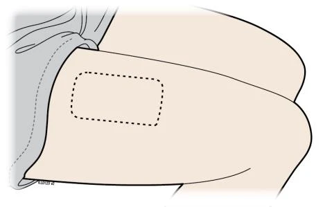Dibujo médico de un brazo con un