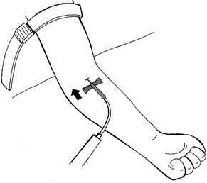 Disegno schematico di un braccio con un dispositivo medico collegato alla pelle e una freccia nera che indica la direzione del movimento
