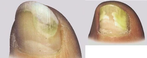 Detalle de dos uñas humanas con placas amarillentas, engrosadas e irregulares que indican una posible infección fúngica u onicomicosis