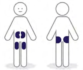 Diagrama estilizado de dos figuras humanas que muestran áreas de aplicación del medicamento en el