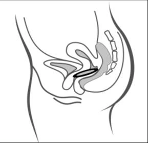Lateral anatomical diagram of the female pelvis showing the
