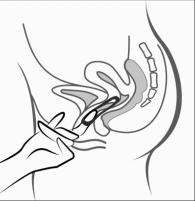 Medical diagram showing a hand inserting an applicator with a drug into a