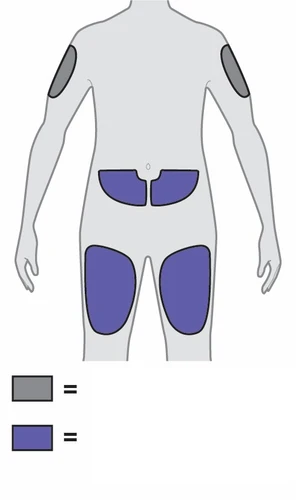 Diagrama del cuerpo humano con áreas grises en los brazos y áreas violetas en la