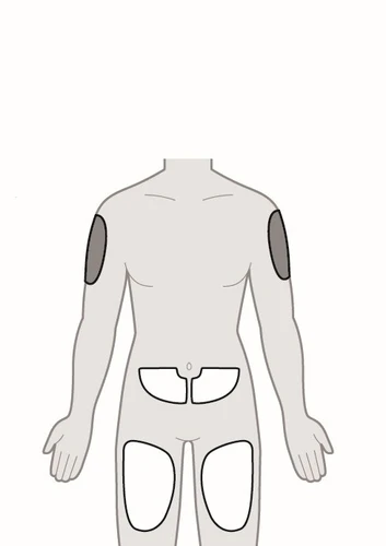 Diagrama del cuerpo humano que muestra áreas blancas delimitadas en brazos, abdomen y muslos para indicar los sitios de aplicación del medicamento