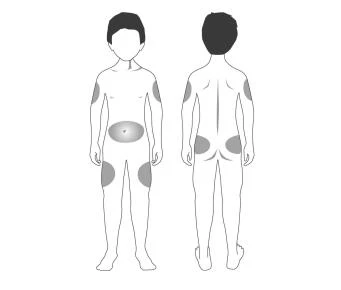 Diagrama estilizado de un cuerpo humano visto de frente y de espalda con manchas grises en hombros, abdomen, muslos y glúteos