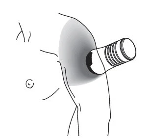 Schematic drawing of a cylindrical medical device placed on the upper arm of a person for