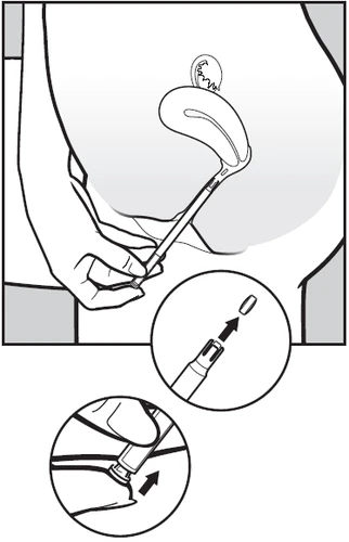 Disegno medico che mostra l'applicazione di un dispositivo sulla pelle del ventre con dettagli sull'inserimento e sul movimento di attivazione