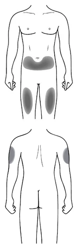 Diagrama del cuerpo humano que muestra áreas grises en la