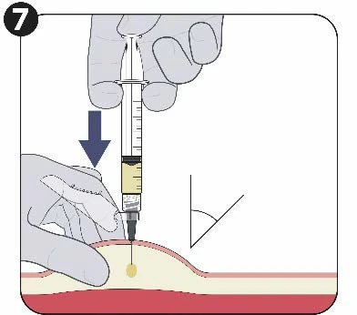 Ilustración médica que muestra una mano sosteniendo una jeringa para inyectar un líquido en un pliegue de piel inclinado a un ángulo específico