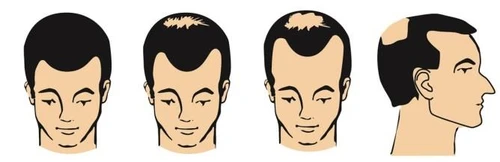 Quattro disegni che mostrano volti di uomini con calvizie progressiva, da capelli pieni a evidenti perdite sulla sommità e sui lati della testa