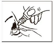 Una mano che tiene una piccola boccetta di collirio, da cui una goccia sta cadendo direttamente nell'occhio di una persona in primo piano