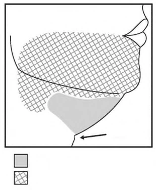 Schematic lateral illustration of the face and neck, highlighting the submental and mandibular areas, with an arrow pointing to the lower neck region