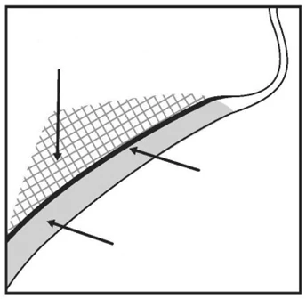 Schematic cross-section of skin layers with three black arrows indicating the epidermis, dermis, and subcutaneous tissue, displayed with a mesh pattern