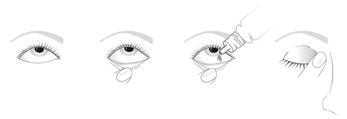 Four diagrams showing the process of administering eye drops, from an open eye, through application of the medication, to closing the eyelids and pressing on the corner of the eye