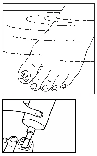 Illustration showing a foot with a diseased nail plate and a hand applying medication from a tube directly onto the toe