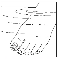 Black-and-white drawing of a human foot showing a pathological lesion or skin condition on the big toe