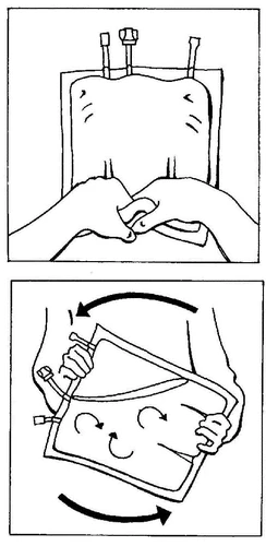 Dos manos sostienen verticalmente una bolsa con líquido y otras manos giran la bolsa lateralmente según flechas curvas para mezclar su contenido