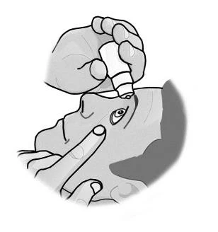 Рука держит маленький белый контейнер и капает капли в глаз человека, в то время как вторая рука аккуратно оттягивает нижнее веко для нанесения препарата
