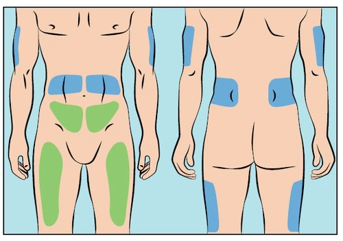 Schematic silhouette of a male figure from front and back, showing injection sites marked in blue on shoulders, abdomen, buttocks, and thighs, and in green on the lower abdomen
