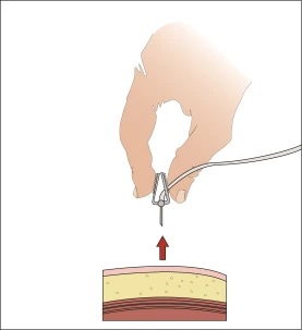 A hand holding a device with a thin needle directed toward a cross-section of skin layers, indicated by a red upward-pointing arrow