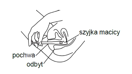 Анатомічна схема, що зображує руку, яка тримає застосування, введене у піхву, з позначками шийка матки, піхва та пряма кишка
