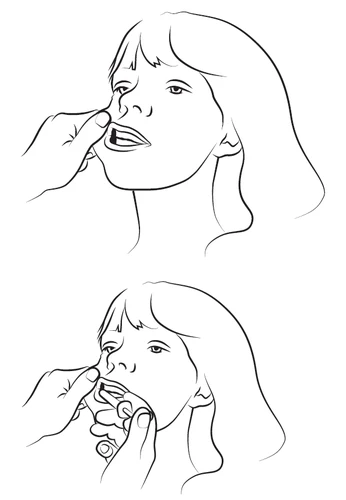 Disegno che mostra due istruzioni: una mano che solleva il labbro inferiore di una donna e un'altra mano che tiene un piccolo oggetto vicino alla sua bocca