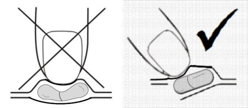 Schema che mostra il posizionamento errato e corretto della capsula sulla lingua, con un disegno della capsula all'interno della bocca barrato e una spunta sul posizionamento corretto sulla lingua