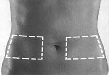 Imagen en blanco y negro del abdomen con dos rectángulos blancos discontinuos que indican los lugares de administración del medicamento a ambos lados del ombligo
