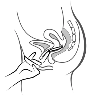 Disegno schematico che mostra una mano che impugna un applicatore inserito nella vagina, in sezione laterale del bacino femminile