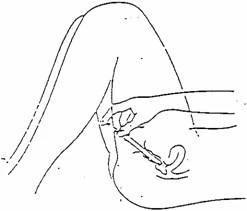 Dibujo esquemático que muestra una mano sosteniendo una jeringa e introduciendo la aguja en ángulo en el pliegue del codo del brazo