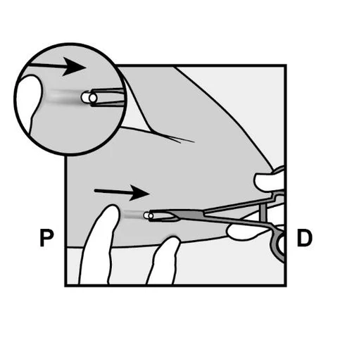 Schematic showing method of drug administration, hand stabilizes the skin, and the medical device is moved in the direction marked with the letter D