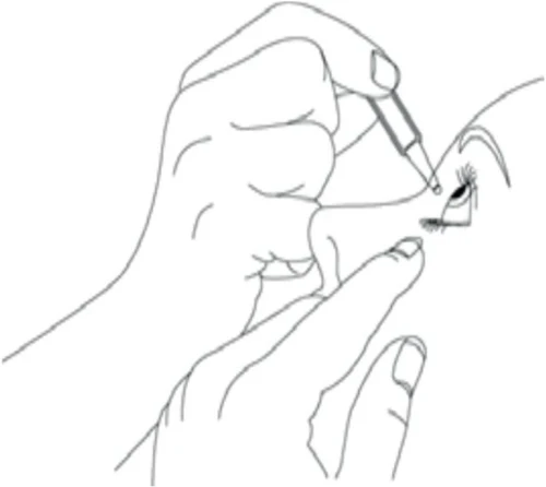 Ilustración que muestra unas manos sosteniendo un ojo y utilizando una pipeta para administrar gotas medicinales directamente en el ojo de una persona